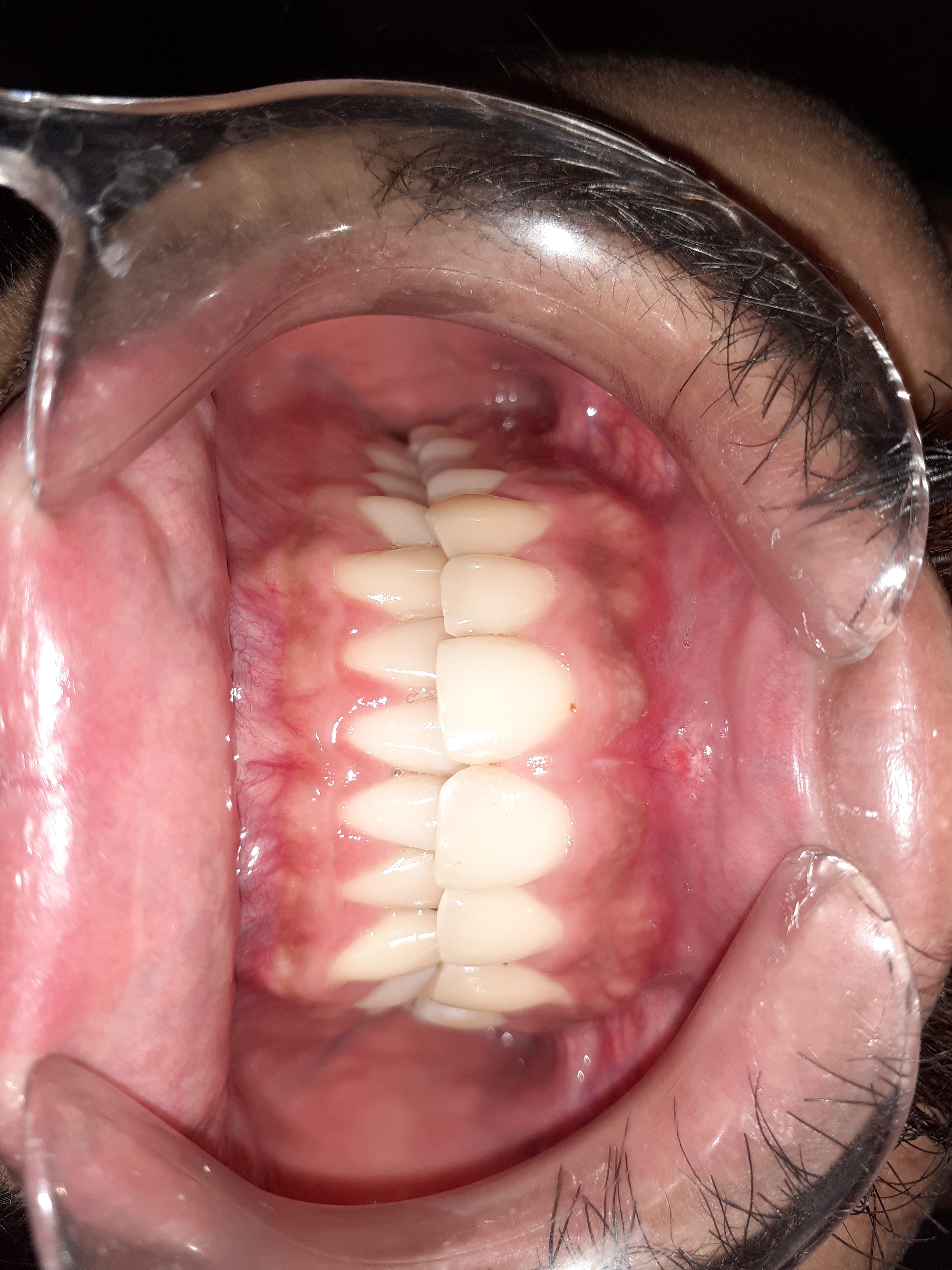 Tooth-Coloured Fillings â€“ after